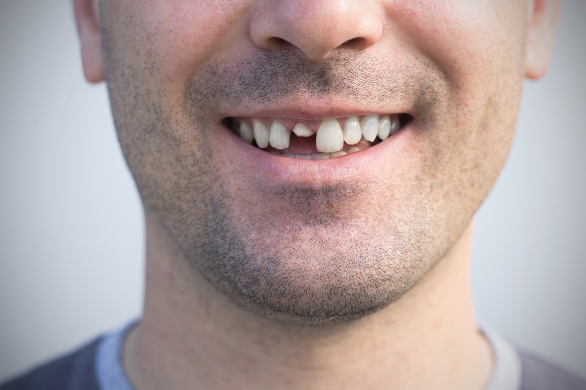Cracked tooth symptoms and when to see a towson endodontist blog